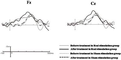 Improved Pre-attentive Processing With Occipital rTMS Treatment in Major Depressive Disorder Patients Revealed by MMN